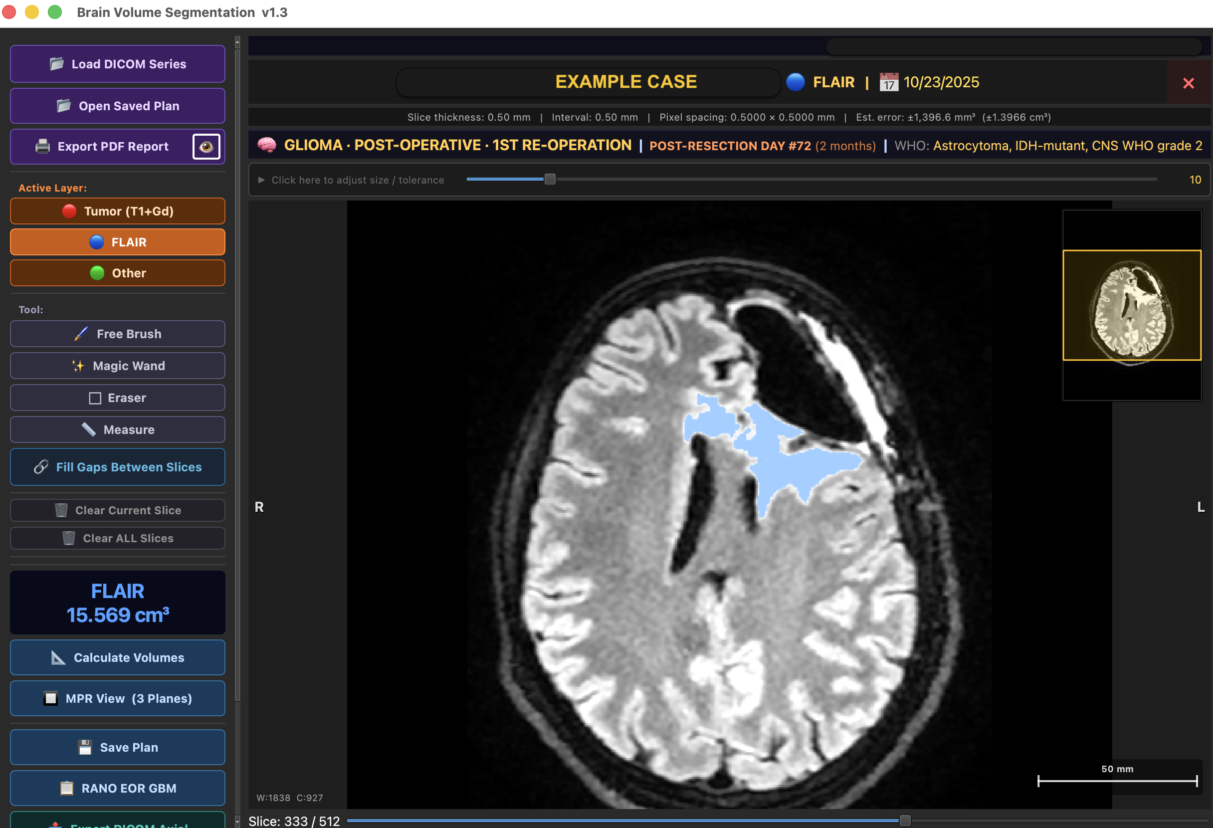 BrainVol app showing FLAIR segmentation of a post-operative glioma case
